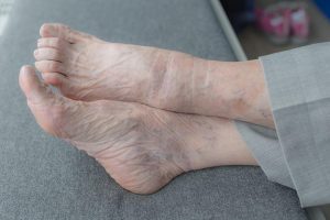 Voordelen bezoek podoloog Apeldoorn: behandeling voetklachten en pijnverlichting